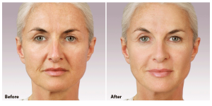 Facial Surgery San Francisco