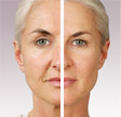 Filler for Facial Rejuvenation Before and After